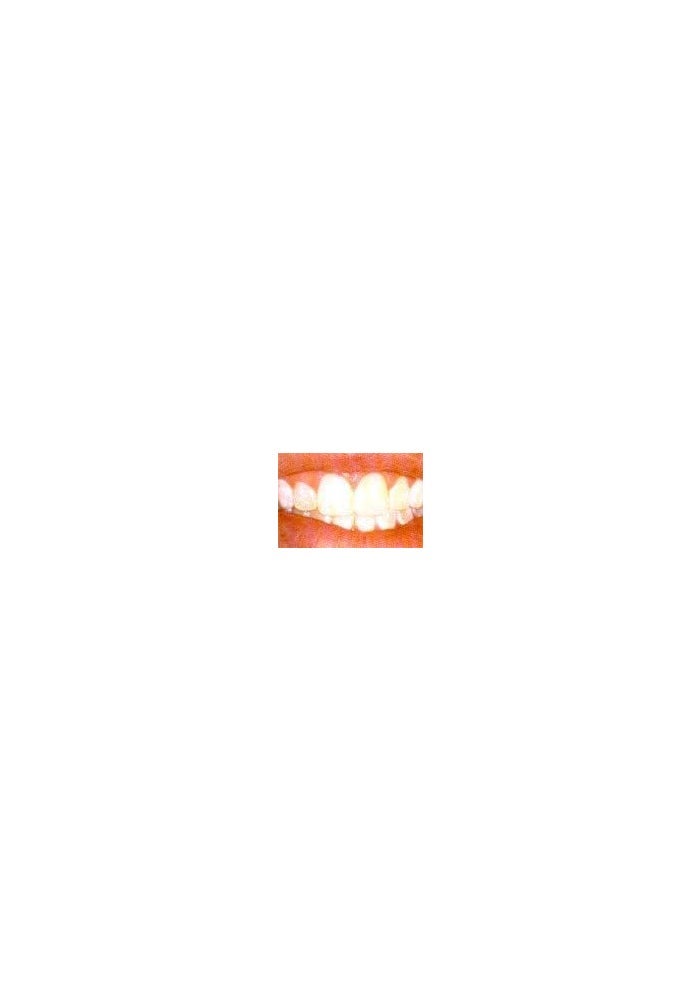 Archtek D.I.Y 10 Thermo-molding 'BOIL and BITE' Mouth Trays for Teeth Whitening - Image 3